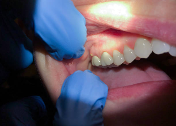 Best Broken or Chipped Tooth Repair in Lisbon, ND